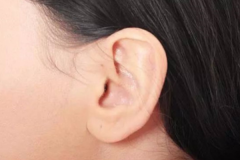小耳畸形矫正?小耳畸形矫正的比较好年龄?