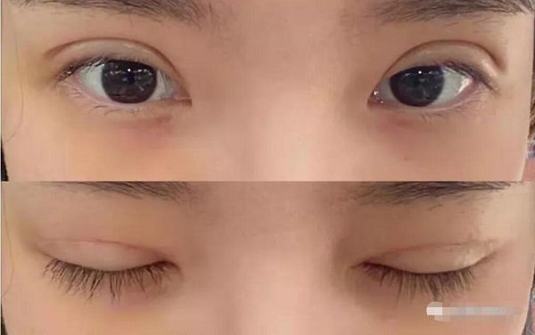 上海医颜医疗美容做全切双眼皮案例(体验过程)分享