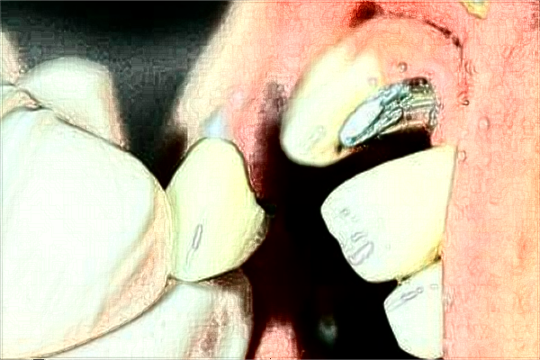 潍坊市人民医院种植牙多少费用?口腔种植牙医生名单