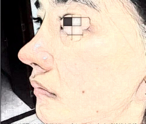 二次鼻修复体验记录：木偶鼻子的修复之路