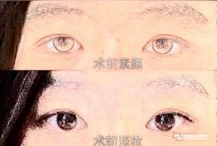 西安西京医院耿健做双眼皮怎么样?全切双眼皮方案+案例+一览