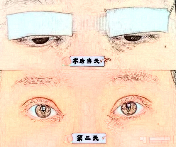 苏大附二院唐红梅三点双眼皮面诊+手术案例（详细体验及恢复过程）