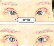 上海九院黄筱琳双眼皮手术过程体验记录,全切双眼皮案例