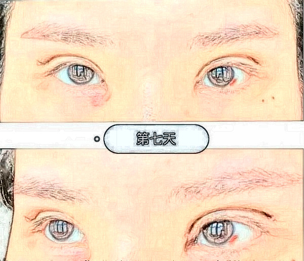 上海九院黄筱琳双眼皮手术过程体验记录（全切双眼皮案例）