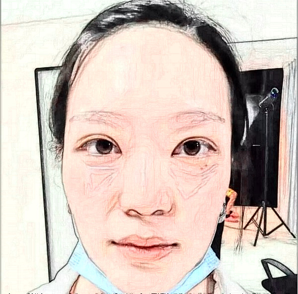 郑州大学附属第一医院玻尿酸填充眼袋+鼻唇沟体验案例反馈