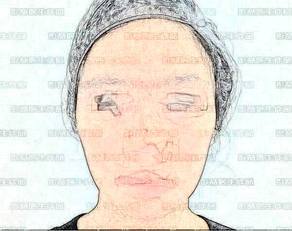 北京航天总医院彭喆下颌角整形面诊记录,改脸型的艰难之路!
