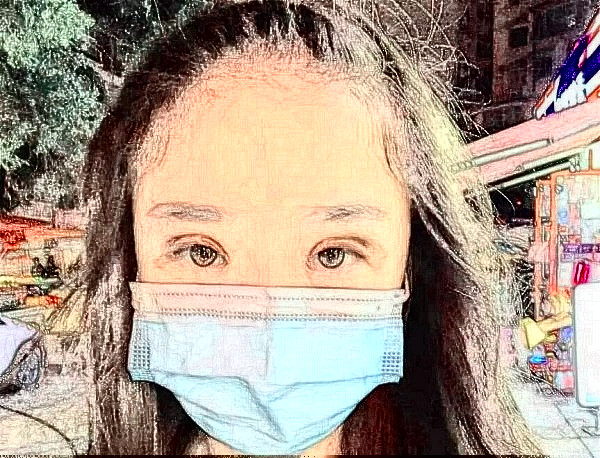 成都傅容双眼皮案例(7mm小平行)分享!体验记录+手术恢复图片