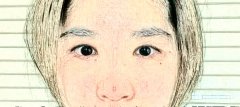 青岛青医附院张维娜双眼皮案例分享,缝合很关键!