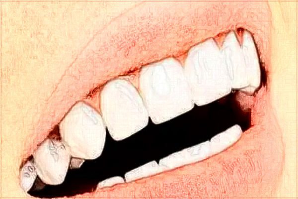 西昌牙博士口腔门诊部牙齿美容价格多少?整形日记全过程分享