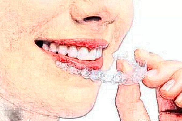 洛阳友好口腔门诊部牙齿贴面收费标准,案例变化分享
