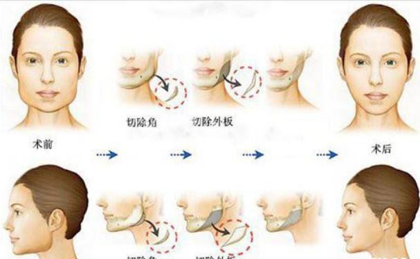 上海下颌角手术哪个医院好?排名前十医院名单一览