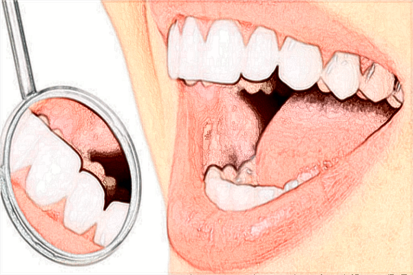 太原众牙口腔全口种植案例分享_医生名单公布！