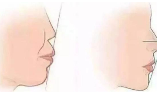 正颌可以改良下颌角吗?正颌可以改良鼻基底凹陷吗