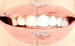 珠海市口腔医院口腔科半口牙种植口碑如何?专家团队简介,含价格多少查询