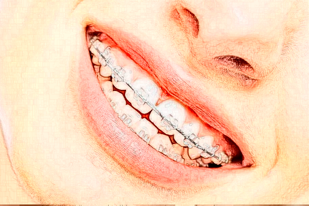 北京大学口腔医院牙齿瓷贴面内容分享参考