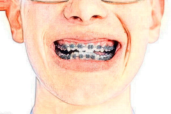 北京大学口腔医院牙齿瓷贴面内容分享参考