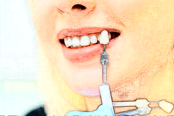 南昌大学附属口腔医院多颗牙种植医生攻略