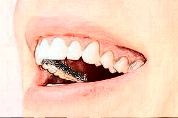 佛山市口腔医院牙齿矫正修复真实案例分享