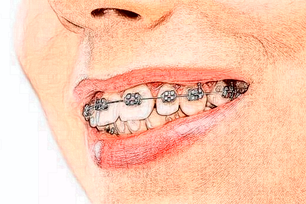 西宁市口腔医院半口牙种植做得好的医生