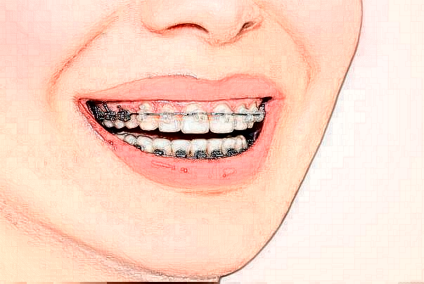 南方科技大学医院牙齿矫正修复可以信赖吗