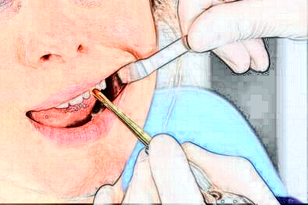 宁波大学附属第一医院多颗牙种植口碑实力正规吗