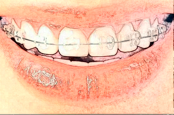 乌鲁木齐市口腔医院牙齿矫正真实案例分享