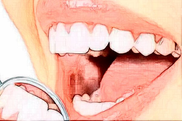 江苏大学附属医院多颗牙种植高赞医生分享